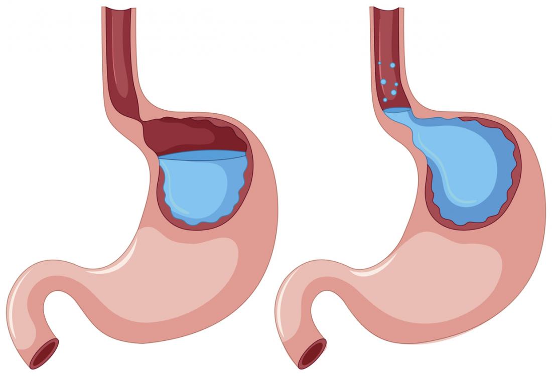 Gastroesophageal Reflux2
