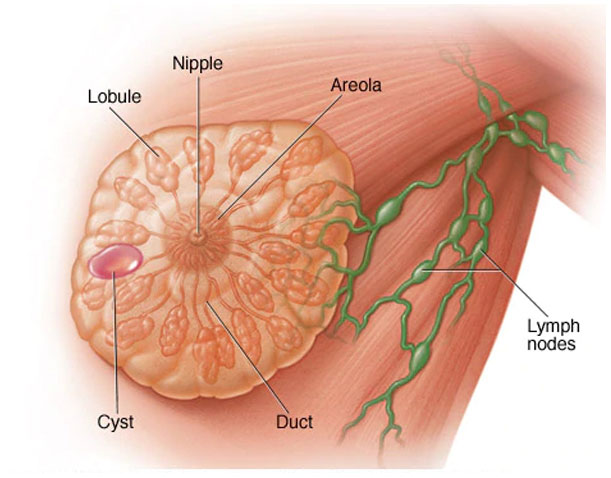 Breast Cyst