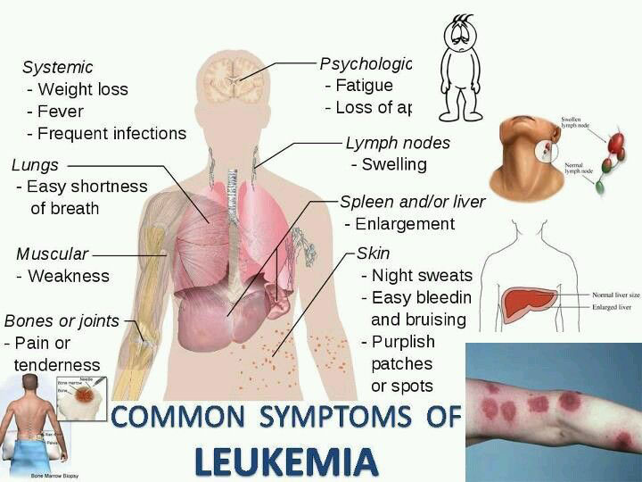 common-symptoms-of-leukemia อาการทั่วไปของมะเร็งเม็ดเลือดขาว