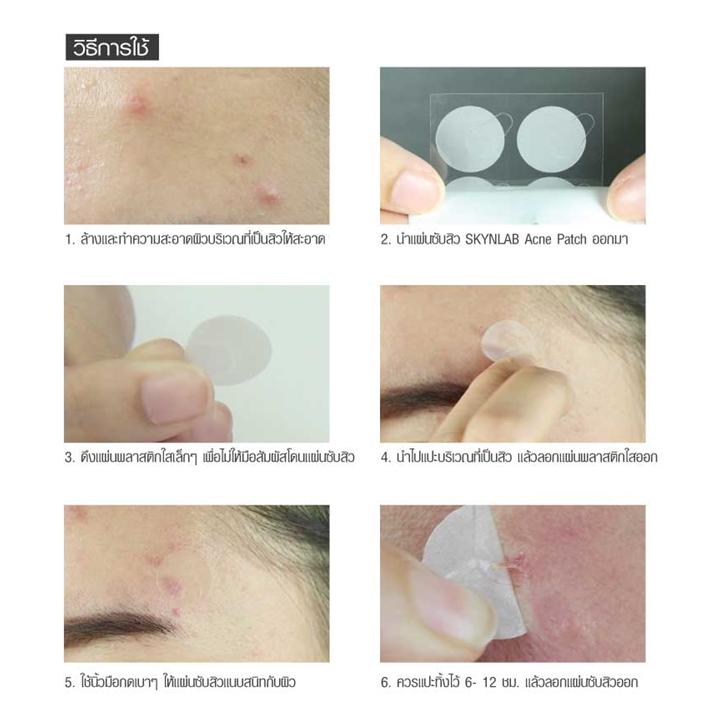 Skynlab Acne Patch 10 ชิ้น แผ่นแปะสิว สกินแล๊บ