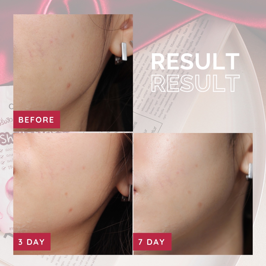 (ุ6ซอง/กล่อง) เซรั่มสิว หอมแดง Clearface Shallot Acne serum