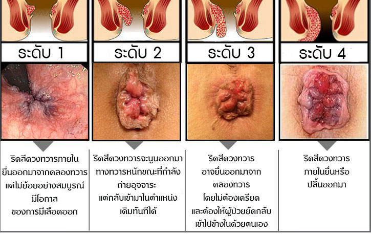 grade of Hemorrhoids ระดับของริดสีดวงทวาร