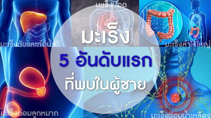 มะเร็ง 5 อันดับแรกที่พบในผู้ชาย