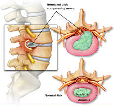 Herniated disc compressing nerve