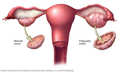Polycystic Ovary ถุงน้ำในรังไข่