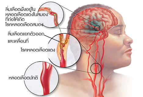 หลอดเลือดสองตีบ