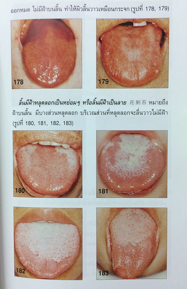 ทฤษฎีแพทย์จีน ลิ้นบอกโรค