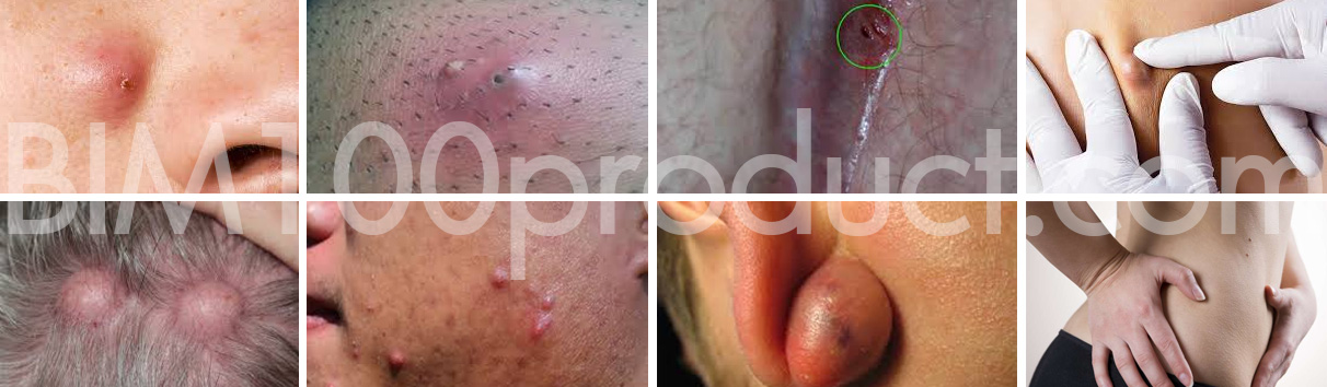 cyst2 cyst2