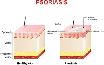 PSORIASIS