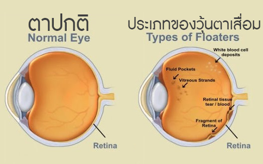 ประเภทตา
