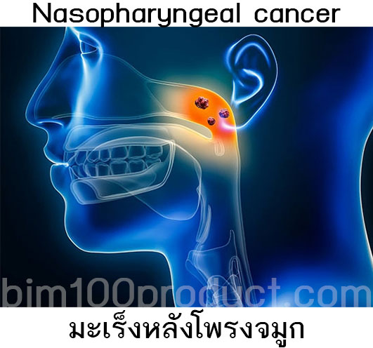 Nasopharyngeal cancer มะเร็งหลังโพรงจมูก