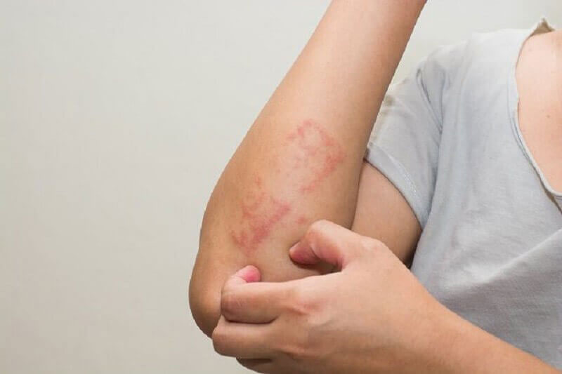 leukemia-purple-red-spots มะเร็งเม็ดเลือดขาวจุดม่วงแดง