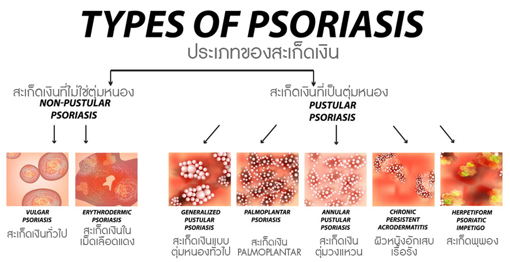 ประเภทของสะเก็ดเงิน