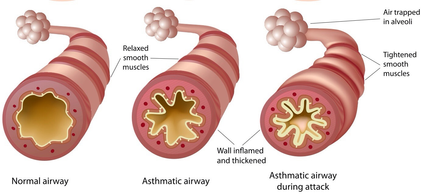 sensitive airways in their lungs