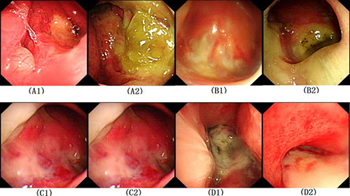Nasopharyngeal-images-of-recurrent-nasopharyngeal-carcinoma-patients-Patients-with-IMRT