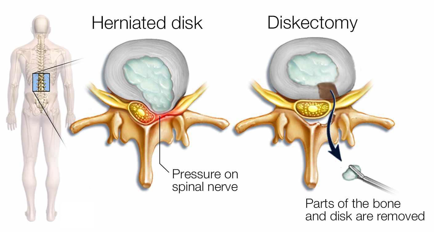 herniated-disk-ectomy