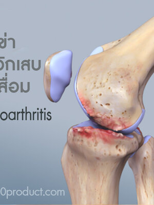BIM100 ประสบการณ์ผู้ใช้กับปัญหาข้อเข่า,ข้ออักเสบ